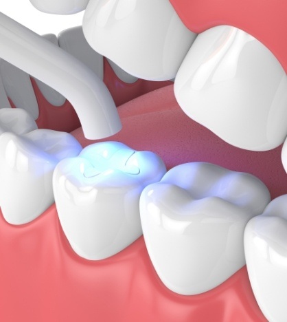 Illustrated dental tool shining ultraviolet light onto dental bonding