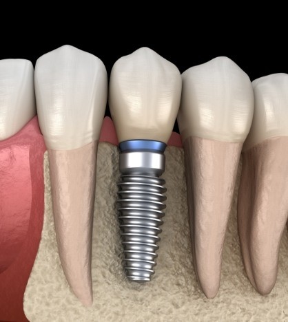 Illustrated dental implant in the lower jawbone replacing a missing tooth