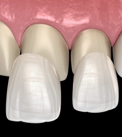 Two illustrated veneers being placed over front teeth